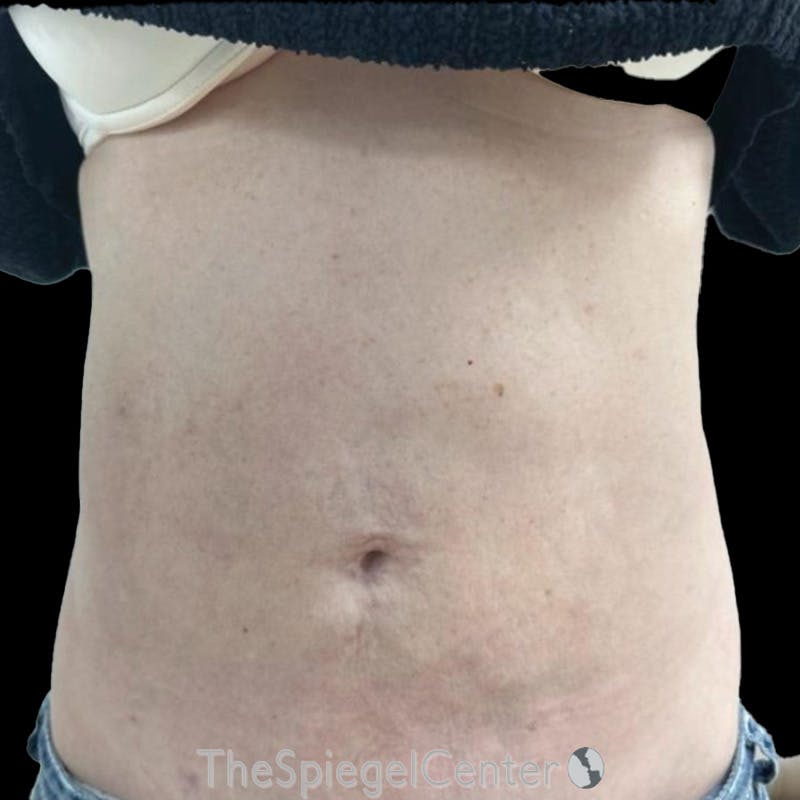 Junera Body Before & After Gallery - Patient 207736 - Image 2