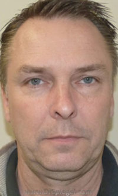 Kybella Before & After Gallery - Patient 424563 - Image 1