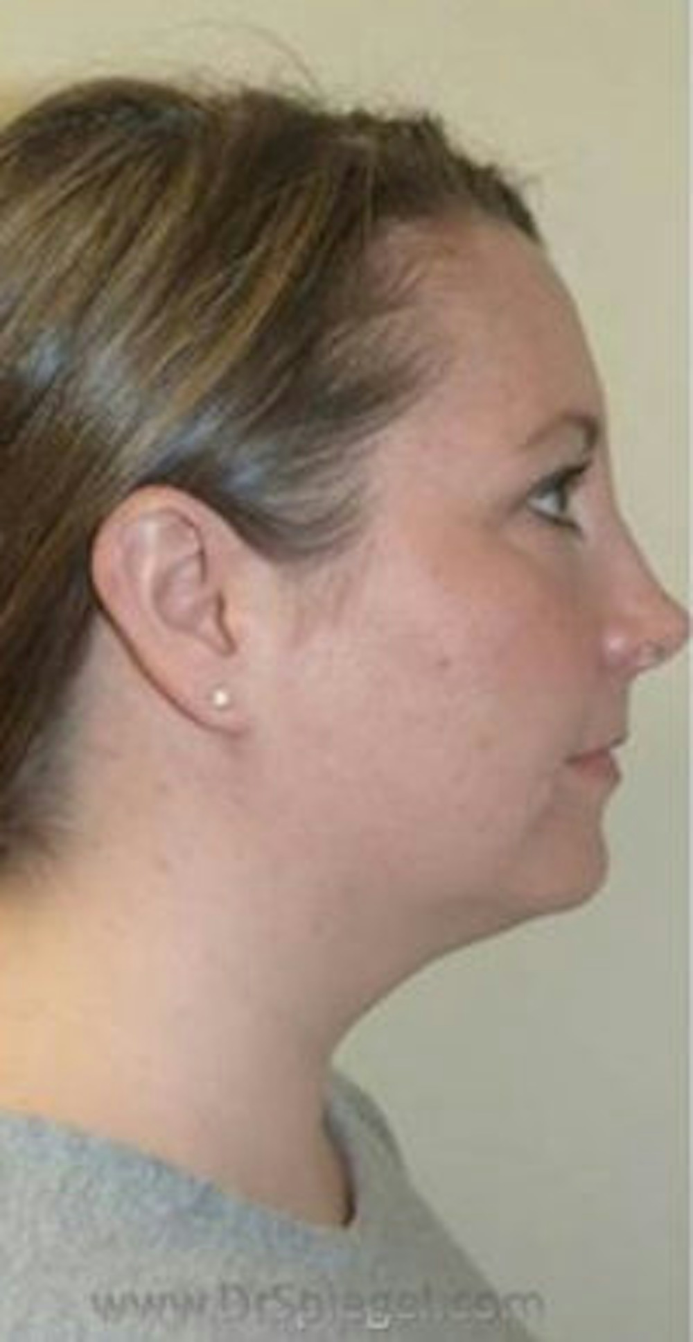 Kybella