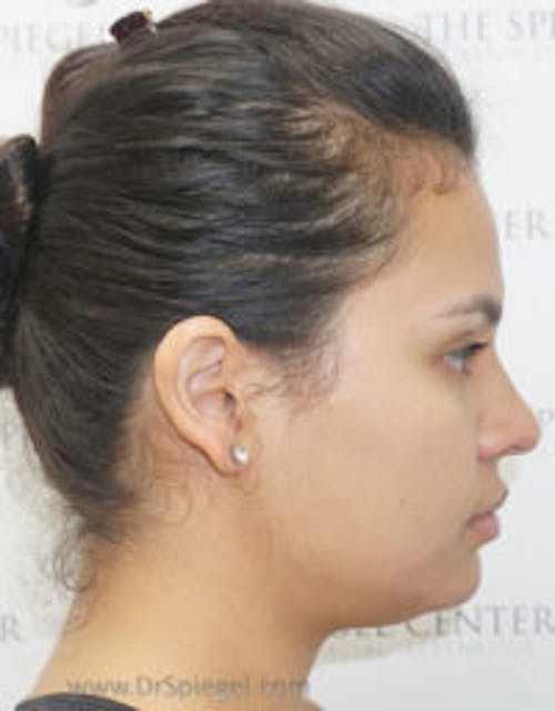 Kybella Before & After Gallery - Patient 266696 - Image 1