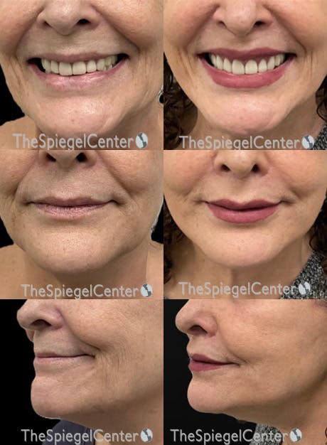 Lip Filler Before & After Gallery - Patient 268598 - Image 1
