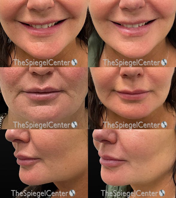 Lip Filler Before & After Gallery - Patient 380425 - Image 1