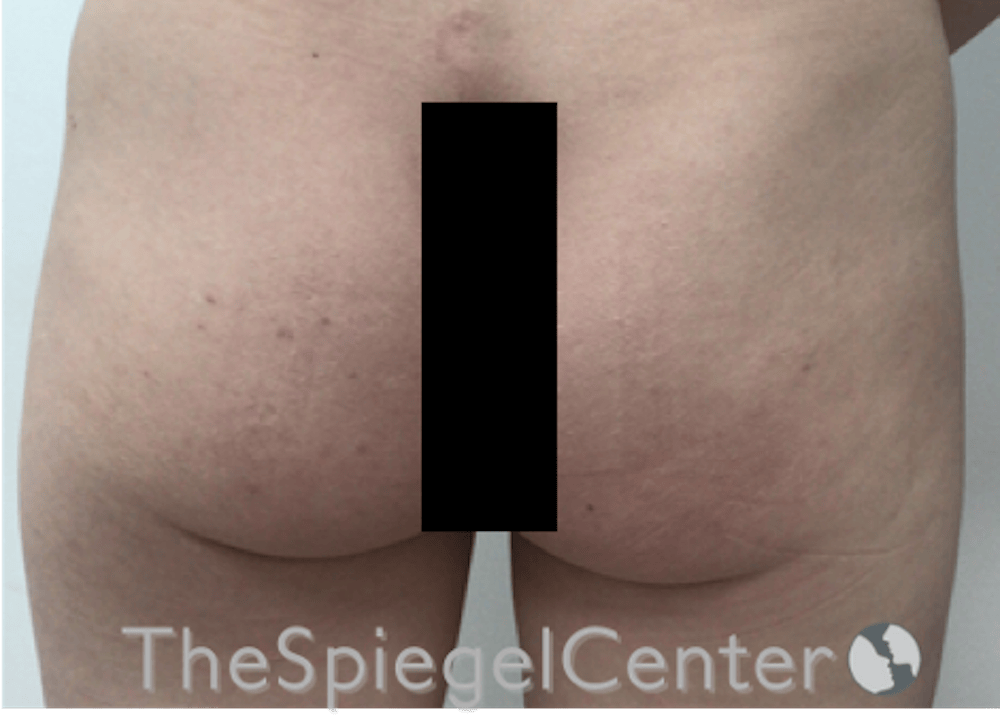 Non-Surgical Butt Lift