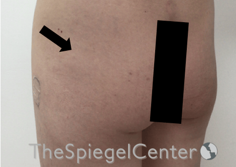 Liquid Butt Lift Before & After Gallery - Patient 257331 - Image 3