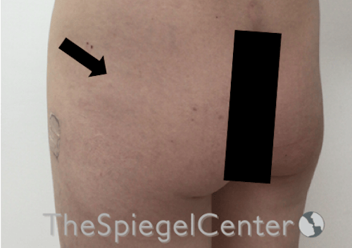 Liquid Butt Lift Before & After Gallery - Patient 257331 - Image 3