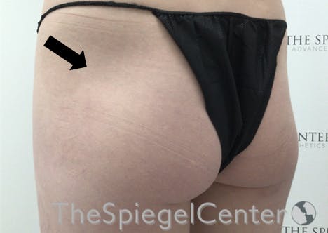 Liquid Butt Lift Before & After Gallery - Patient 257331 - Image 4
