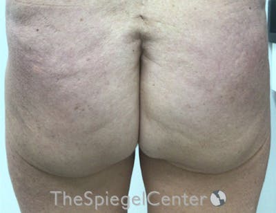 Liquid Butt Lift Before & After Gallery - Patient 325898 - Image 1