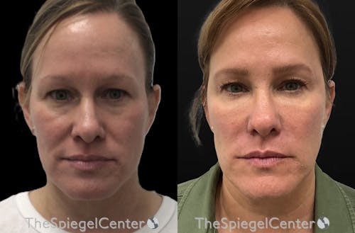 Liquid Face Lift Before & After Gallery - Patient 322863 - Image 1