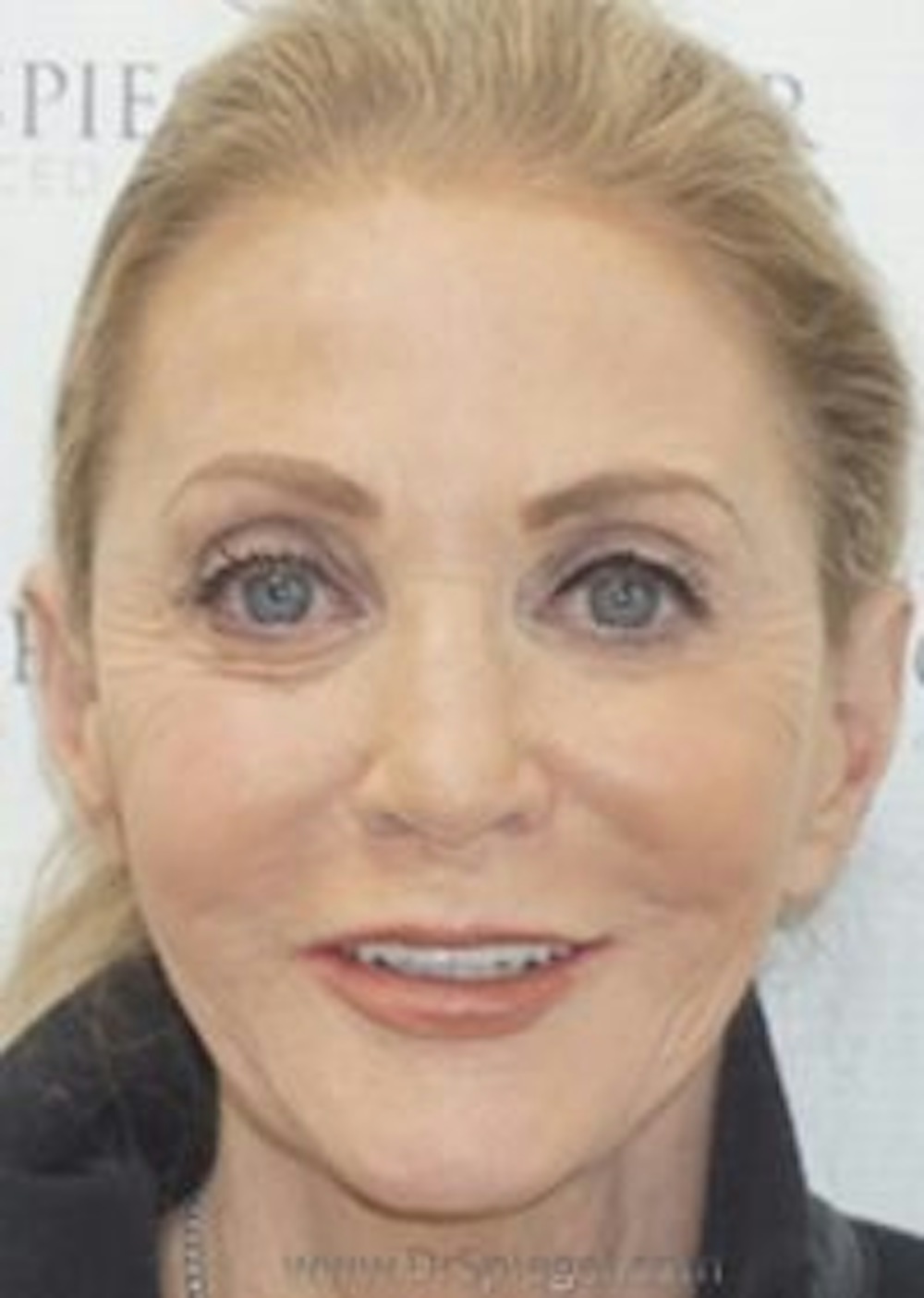 Liquid Facelift