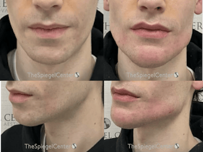 Mandible Jaw Filler Before & After Gallery - Patient 406047 - Image 1