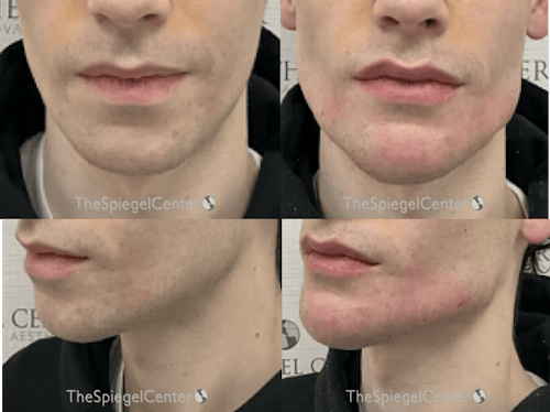 Mandible Jaw Filler Before & After Gallery - Patient 406047 - Image 1