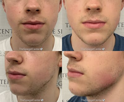 Chin Filler Before & After Gallery - Patient 129665 - Image 1