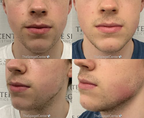 Chin Filler Before & After Gallery - Patient 129665 - Image 1