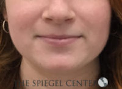 Mandible Jaw Filler Before & After Gallery - Patient 211672 - Image 1