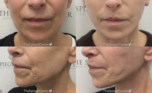 Marionette Line Filler Before & After Gallery - Patient 404759 - Image 1