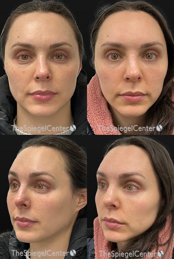 Masseter Botox Before & After Gallery - Patient 118350 - Image 1