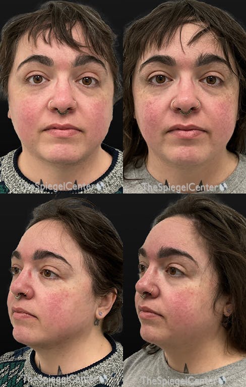 Masseter Botox Before & After Gallery - Patient 405367 - Image 1