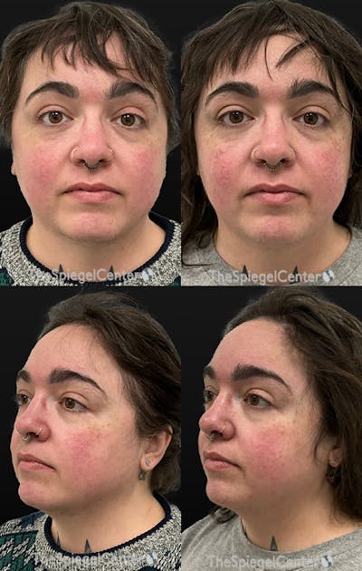Masseter Botox Before & After Gallery - Patient 405367 - Image 1