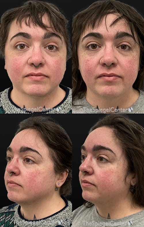 Masseter Botox Before & After Gallery - Patient 405367 - Image 1