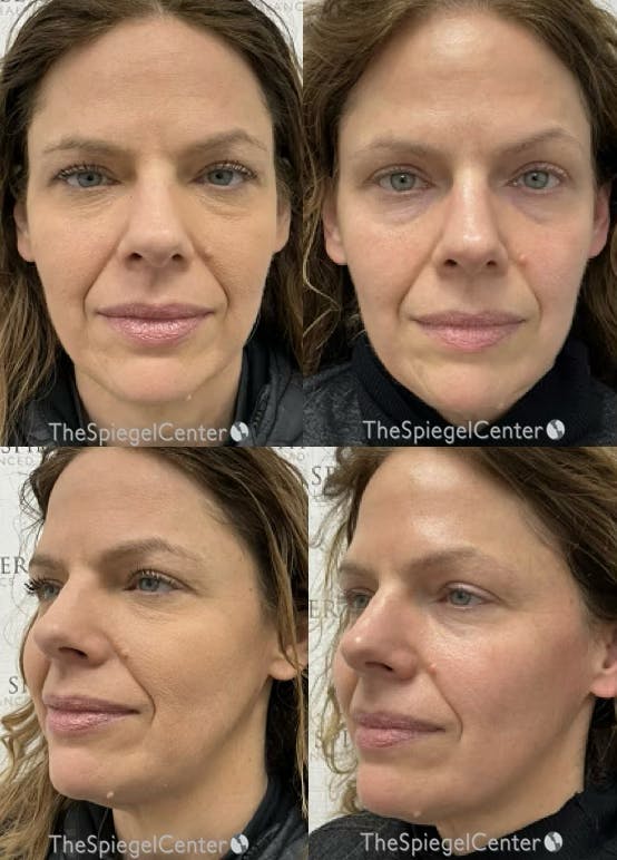 Masseter Botox Before & After Gallery - Patient 214002 - Image 1
