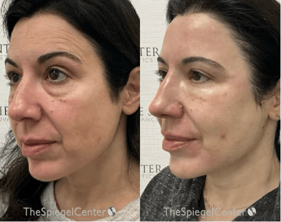 Morpheus8 Before & After Gallery - Patient 129392 - Image 1
