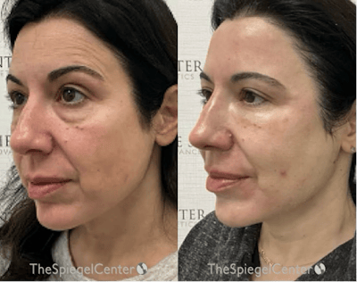 Morpheus8 Before & After Gallery - Patient 129392 - Image 1