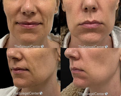 Nasolabial Fold Filler Before & After Gallery - Patient 114124 - Image 1
