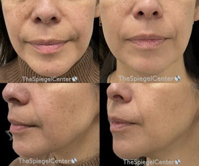 Nasolabial Fold Filler Before & After Gallery - Patient 400485 - Image 1