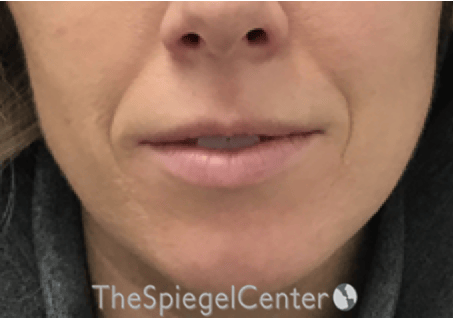 Nasolabial Fold Filler Before & After Gallery - Patient 309056 - Image 1