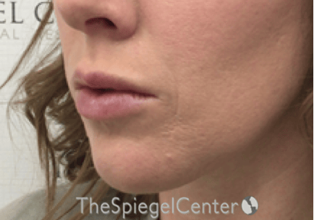 Nasolabial Fold Filler Before & After Gallery - Patient 309056 - Image 4
