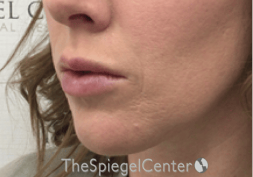 Nasolabial Fold Filler Before & After Gallery - Patient 309056 - Image 4