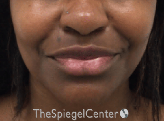 Nasolabial Fold Filler Before & After Gallery - Patient 117666 - Image 1