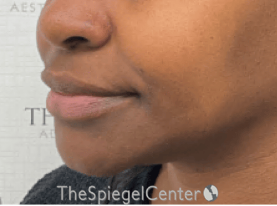 Nasolabial Fold Filler Before & After Gallery - Patient 117666 - Image 4