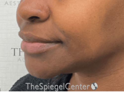 Nasolabial Fold Filler Before & After Gallery - Patient 117666 - Image 4