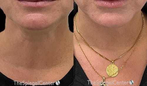 Neck Botox Before & After Gallery - Patient 420170 - Image 1