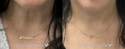 Neck Botox Before & After Gallery - Patient 361109 - Image 1