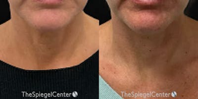 Neck Botox Before & After Gallery - Patient 239770 - Image 1