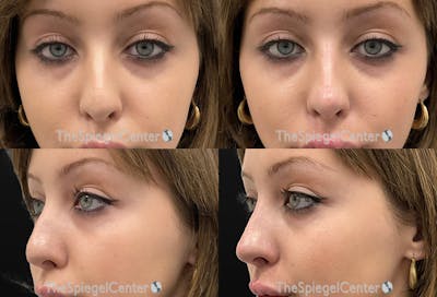Non-Surgical Rhinoplasty / Nose Filler Before & After Gallery - Patient 417333 - Image 1