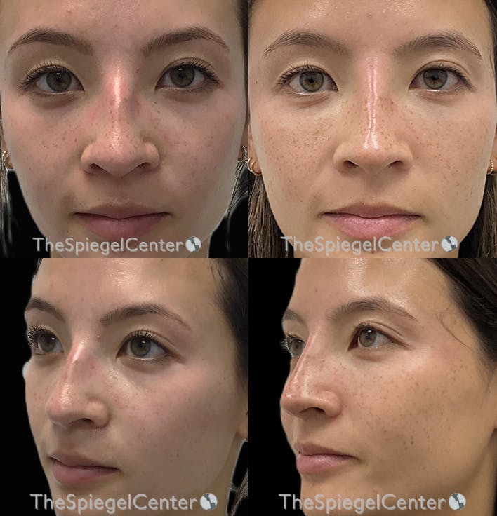 Non-Surgical Rhinoplasty / Nose Filler Before & After Gallery - Patient 403942 - Image 1