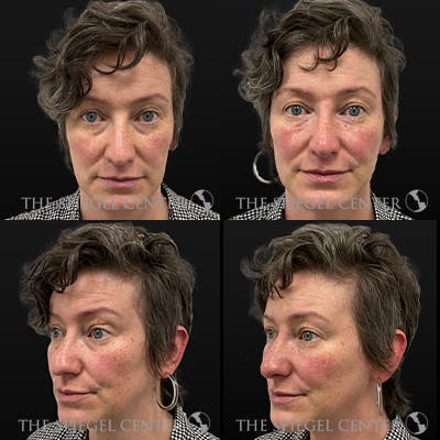 Non-Surgical Rhinoplasty / Nose Filler Before & After Gallery - Patient 186693 - Image 1
