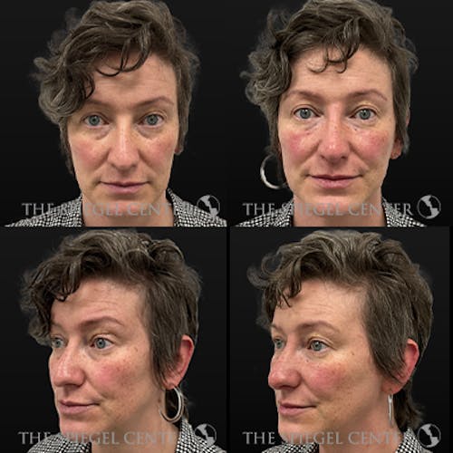 Non-Surgical Rhinoplasty / Nose Filler Before & After Gallery - Patient 186693 - Image 1