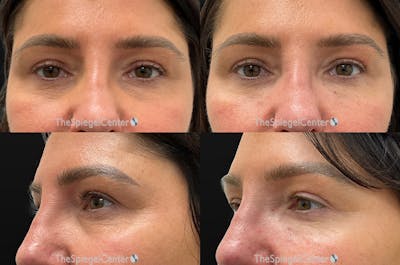 Tear Trough / Under Eye Fillers Before & After Gallery - Patient 390068 - Image 1