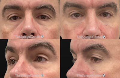 Tear Trough / Under Eye Fillers Before & After Gallery - Patient 705016 - Image 1