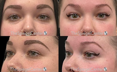 Tear Trough / Under Eye Fillers Before & After Gallery - Patient 808250 - Image 1