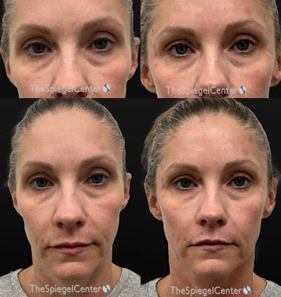 Temple Filler Before & After Gallery - Patient 375810 - Image 1