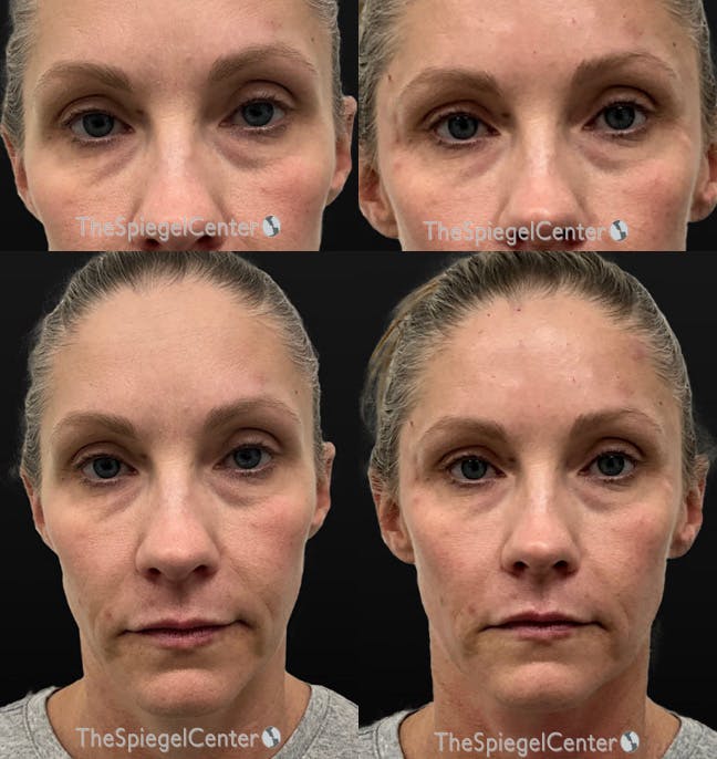 Temple Filler Before & After Gallery - Patient 375810 - Image 1