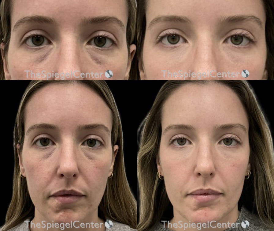 Temple Filler Before & After Gallery - Patient 370621 - Image 1
