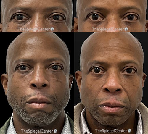 Temple Filler Before & After Gallery - Patient 193711 - Image 1