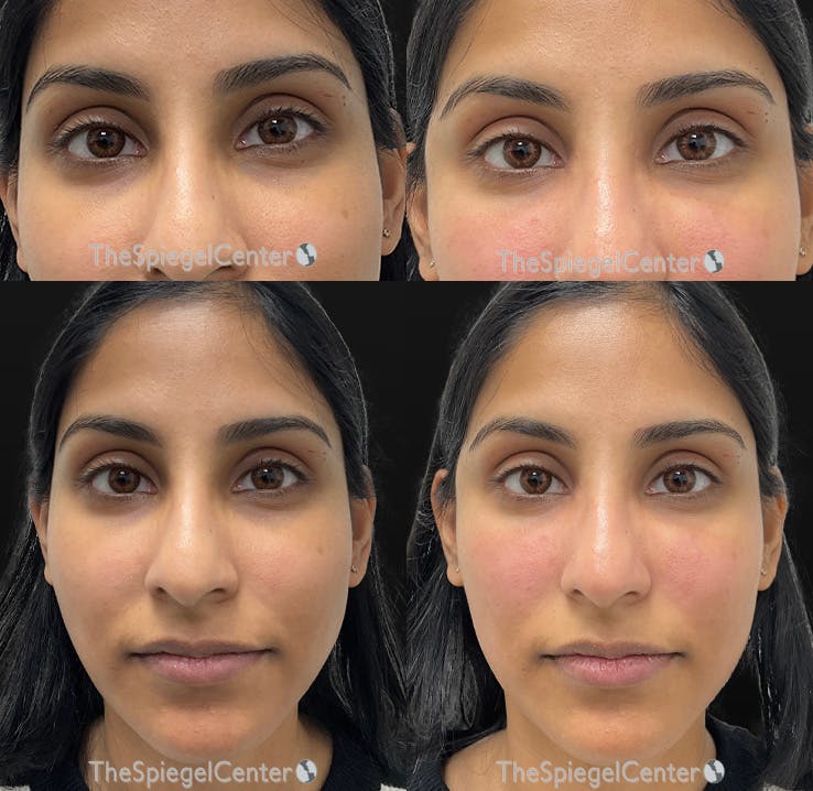 Temple Filler Before & After Gallery - Patient 252257 - Image 1