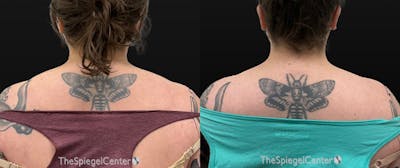Trapezius Botox (TrapTox) Before & After Gallery - Patient 127851 - Image 1